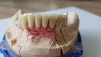implantatgetragener Zahnersatz - Zahnfleischanteile aus Keramik